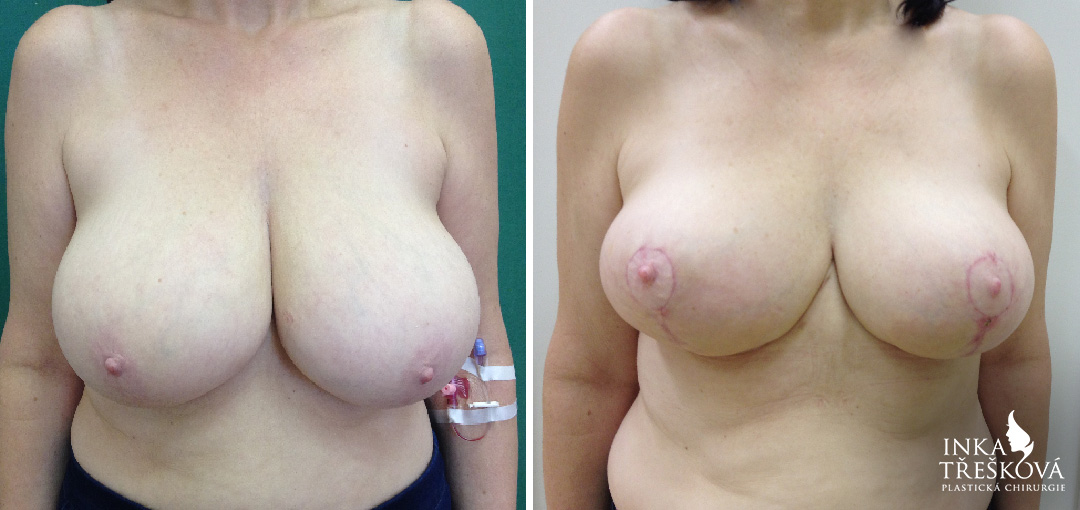Zmenšení prsou foto před a po